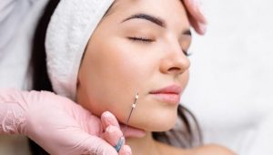 The Power of a Thread Lift